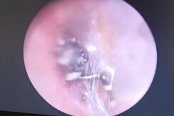 Watch: Chinese Woman Suffering From Ear Pain Finds Spider Nesting Inside Watch: Chinese Woman Suffering From Ear Pain Finds Spider Nesting Inside