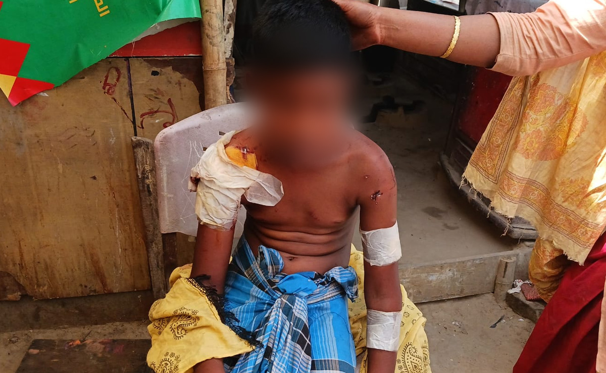 Delhi Boy Mauled By Dogs At Same Place Where 2 Children Killed By Strays In March