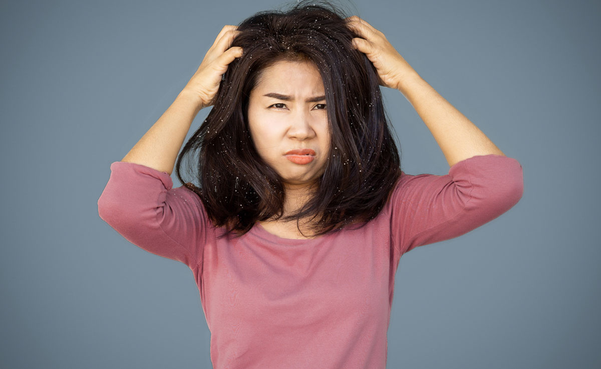 7 DIY Hair Mask Recipes To Get Rid Of Dandruff Naturally At Home