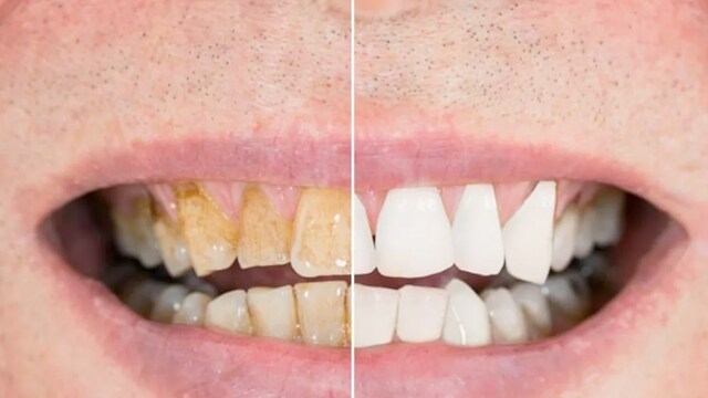 Along with good oral hygiene, you must avoid these practices for better dental health