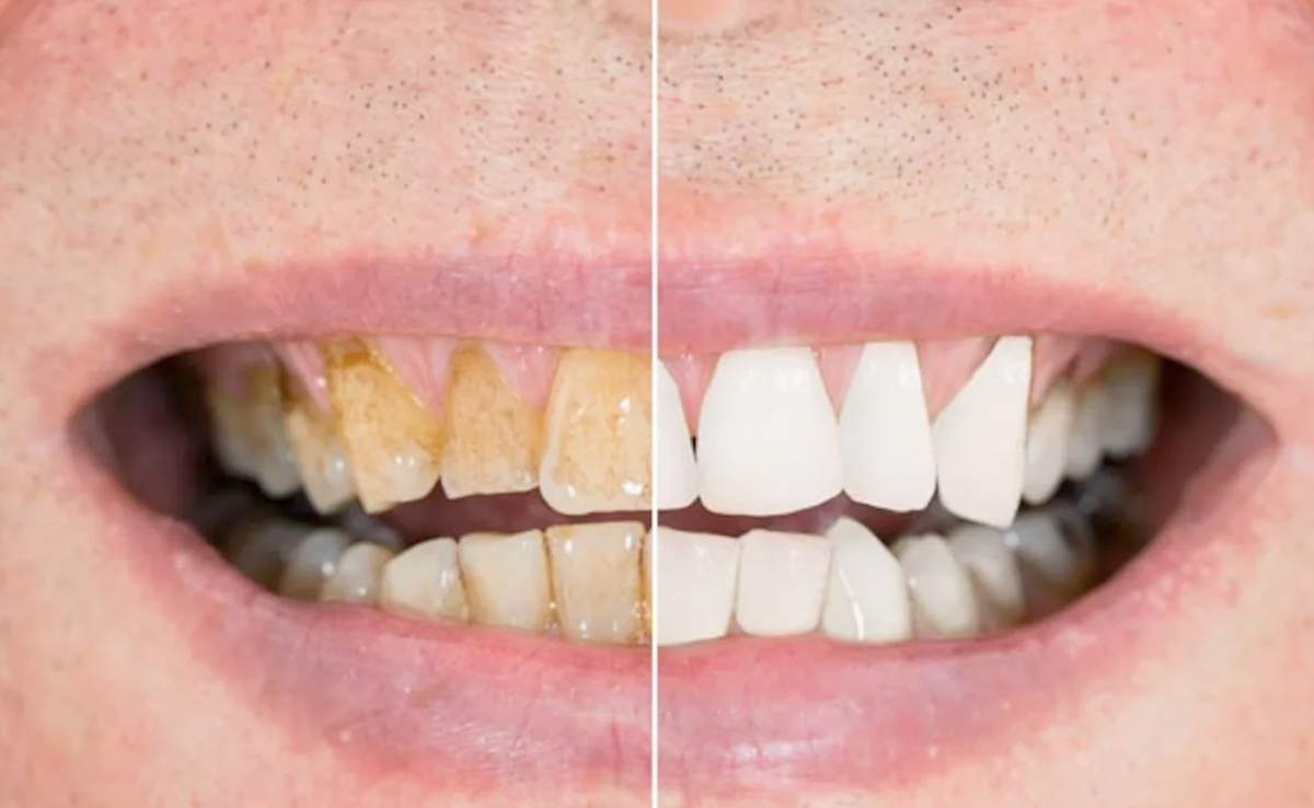 Along with good oral hygiene, you must avoid these practices for better dental health