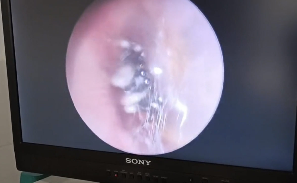 Watch: Chinese Woman Suffering From Ear Pain Finds Spider Nesting Inside