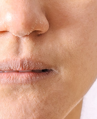 Habits To Avoid Dry Skin In Winter