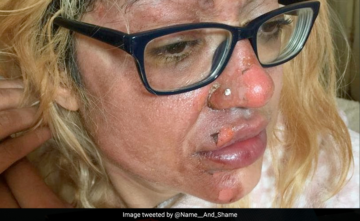 Woman Follows Viral TikTok Hack To Cook Egg, Left With Skin Peeling From Face