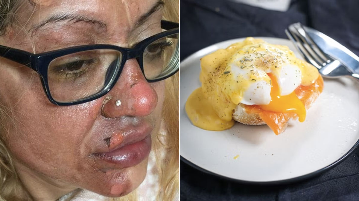 After Using Microwave Hack To Cook Eggs, Woman Injures And Burns Her Face