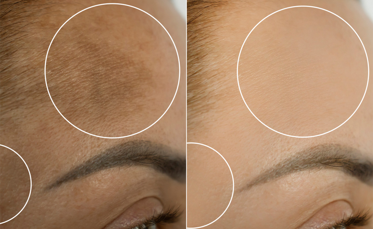 Forehead Tanning: धूप से माथा पड़ गया है काला तो आजमाइए दूध और बेसन का रामबाण नुस्खा, दूर कर देगा सारी Tanning