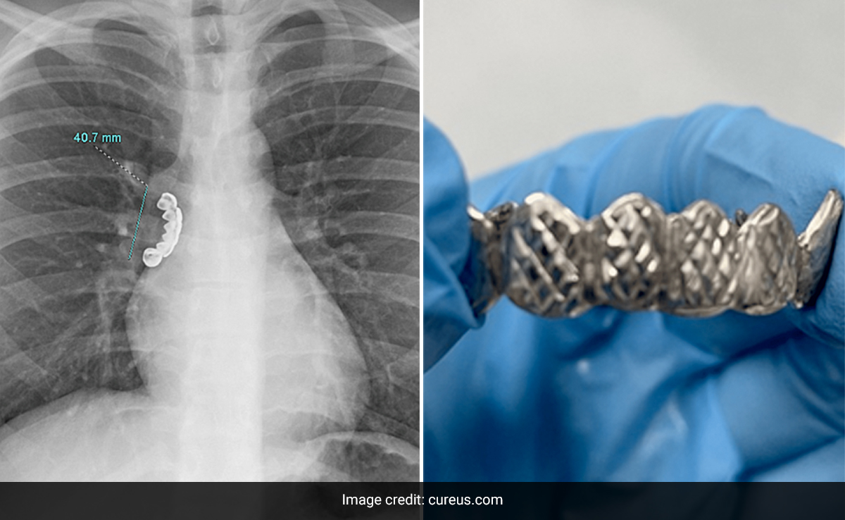 Man Gets Dentures Stuck In His Lungs After Accidentally Swallowing Them