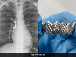 Man Gets Dentures Stuck In His Lungs After Accidentally Swallowing Them Man Gets Dentures Stuck In His Lungs After Accidentally Swallowing Them