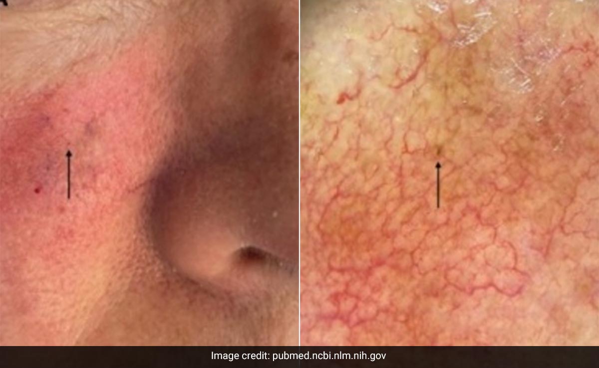 Almost Invisible Spot Under Woman's Eye Turns Out To be World's Smallest Skin Cancer