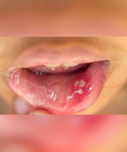 मुंह के छालों से राहत चाहिए तो तुरंत आजमाएं ये 3 घरेलू नुस्खे, हमेशा के लिए मिल जाएगा छालों से छुटकारा