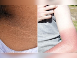 धूप ने काली कर दी है गर्दन, तो आलू, दही और फ‍िटकरी से म‍िनटों में यूं दूर करें टैन‍िंग