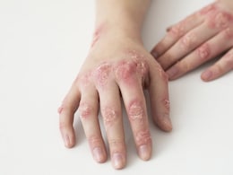 Ever Heard Of Jock Itch Or Tinea? Why That Rash Might Be More Than Just Irritation