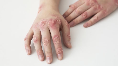 Can Eating Non-Vegetarian Food Cause Skin Allergies? Expert Explains Rare Reaction