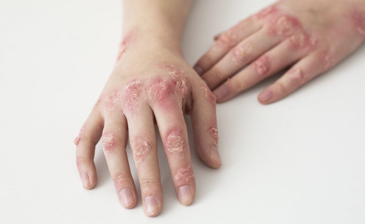 Persistent itchy rashes may be fungal infections like tinea, not irritation, seek proper treatment.