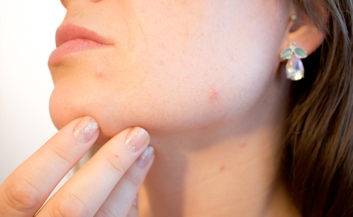 ''It Bled And Bled'': Pimple On Woman's Nose Turns Out To Be Skin Cancer