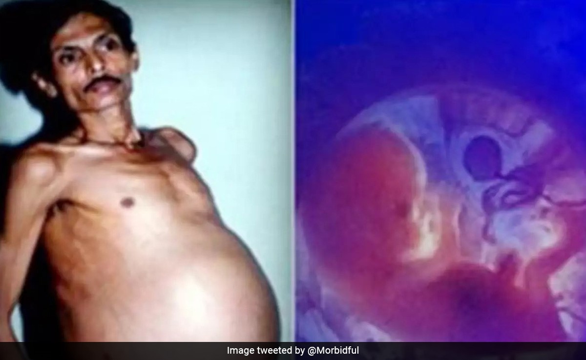 36 साल से प्रेग्नेंट रहा शख्स, ऑपरेशन हुआ तो निकले जुड़वा बच्चे,  50 लाख में से एक के साथ ऐसा होता है