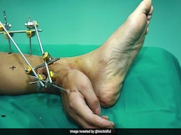 चीन के डॉक्टरों ने कर डाला करिश्मा, कटे हाथ को पहले पैर से जोड़ा, फिर जो किया वो अजूबे से कम नहीं चीन के डॉक्टरों ने कर डाला करिश्मा, कटे हाथ को पहले पैर से जोड़ा, फिर जो किया वो अजूबे से कम नहीं