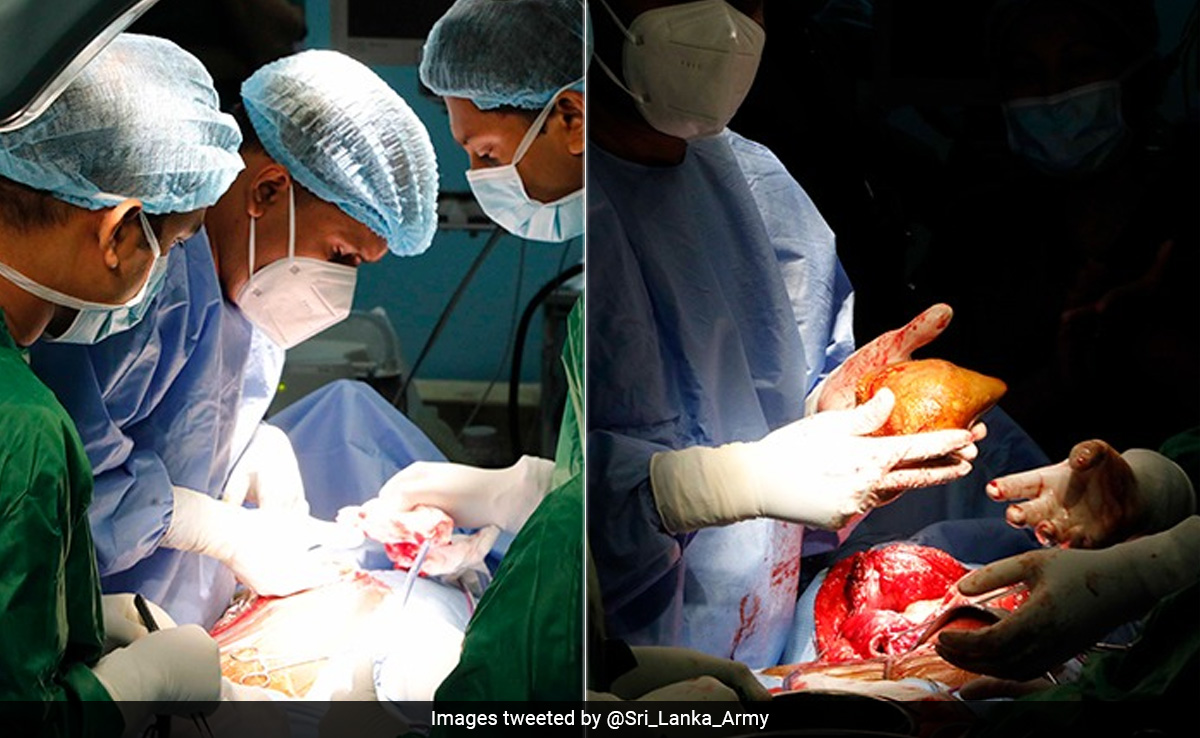 श्रीलंकाई सेना के चिकित्सकों ने दुनिया में गुर्दे की सबसे बड़ी पथरी निकाली, गिनीज वर्ल्ड रिकॉर्ड