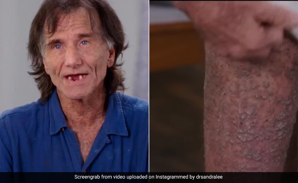 Man With "Crocodile-Like Skin" On His Struggle: "Clothes Hurt So Bad"