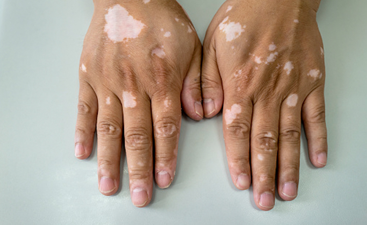 World Vitiligo Day 2023: विटिलिगो की दिक्कत से परेशान लोग आजमा सकते हैं ये 6 घरेलू उपाय, सफेद दागों पर दिखने लगेगा असर 