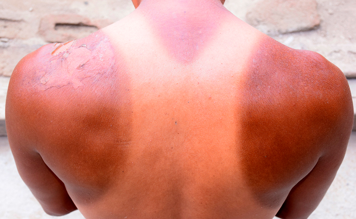 सनबर्न हो गया है तो घर की इस एक चीज को लगाकर देख लीजिए आज ही, मिल जाएगी राहत