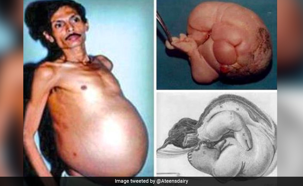 In Rare Medical Condition, Nagpur Man Was 'Pregnant' With Twin For 36 Years