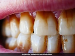 ब्रश करने के बाद भी नहीं हट रहा दांतों का पीलापन, दिन में 2 बार इस चीज से करें साफ, कुदरती सफेद हो सकते हैं आपके दांत ब्रश करने के बाद भी नहीं हट रहा दांतों का पीलापन, दिन में 2 बार इस चीज से करें साफ, कुदरती सफेद हो सकते हैं आपके दांत