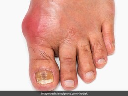 बढ़े हुए यूरिक एसिड को कंट्रोल करने के लिए खानपान में कर लीजिए ये 3 बदलाव, High Uric Acid होने लगेगा कम  बढ़े हुए यूरिक एसिड को कंट्रोल करने के लिए खानपान में कर लीजिए ये 3 बदलाव, High Uric Acid होने लगेगा कम