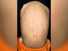 तपती धूप से निकल आई हैं घमौरियां, तो ये आसान से 5 घरेलू उपाय दिक्कत दूर करके देंगे राहत  तपती धूप से निकल आई हैं घमौरियां, तो ये आसान से 5 घरेलू उपाय दिक्कत दूर करके देंगे राहत