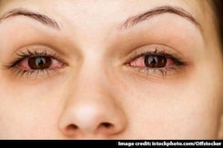 Conjunctivitis An Epidemic In Delhi? What Experts Say Conjunctivitis An Epidemic In Delhi? What Experts Say