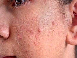 Monsoon Skin Care: मॉनसून में स्किन पर फोड़े-फुंसियों को रोकेंगे कुछ तरीके, इन टिप्स से स्किन बनी रहेगी बेदाग Monsoon Skin Care: मॉनसून में स्किन पर फोड़े-फुंसियों को रोकेंगे कुछ तरीके, इन टिप्स से स्किन बनी रहेगी बेदाग