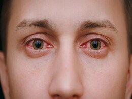 आई फ्लू को ठीक करने के लिए डॉक्टर ने बताया यह नुस्खा, तेजी से ठीक होगी Eye Flu की दिक्कत आई फ्लू को ठीक करने के लिए डॉक्टर ने बताया यह नुस्खा, तेजी से ठीक होगी Eye Flu की दिक्कत