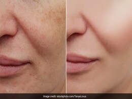 स्किन एक्सपर्ट ने बताया 1 हफ्ते में चेहरे की झाईं ठीक करने वाला फेस पैक, घर पर चुटकियों में हो जाएगा तैयार स्किन एक्सपर्ट ने बताया 1 हफ्ते में चेहरे की झाईं ठीक करने वाला फेस पैक, घर पर चुटकियों में हो जाएगा तैयार