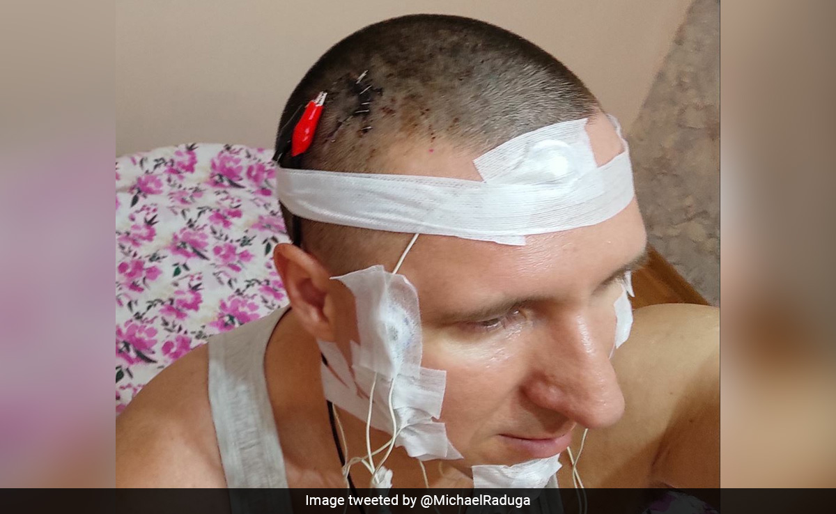 Russian Man Almost Dies After Drilling Chip Inside Brain In Surgery At Home