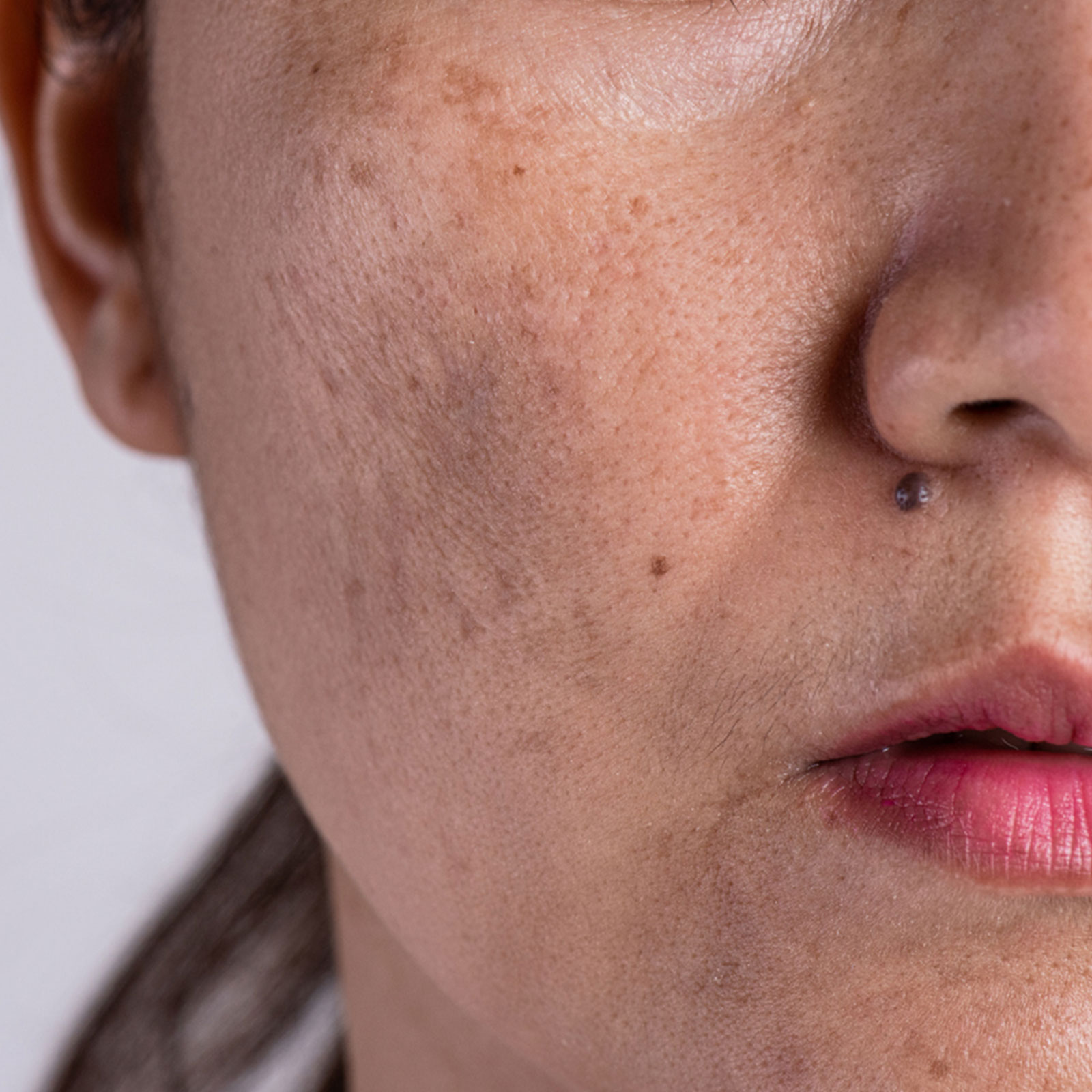 आचार्य बालकृष्ण के उपाय, पिगमेंटेशन का कैसे करें घरेलू इलाज?