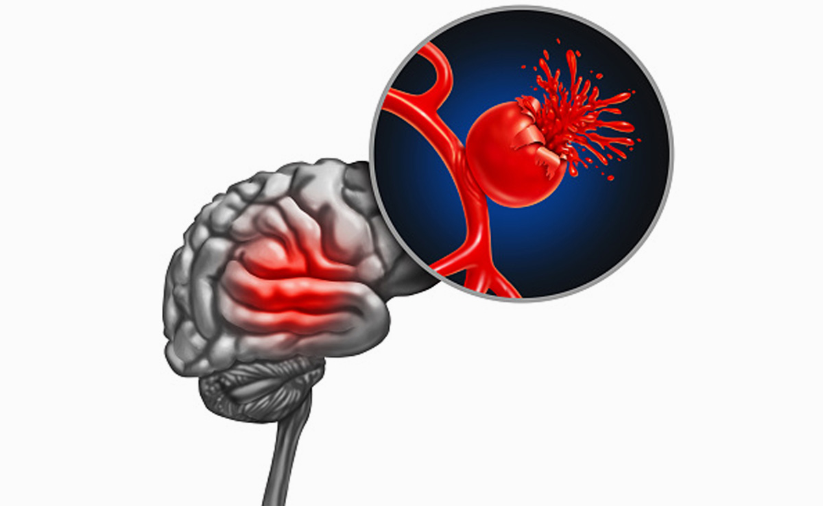 दिमाग की नसों पर बन जाती हैं बेर जैसी गांठें, अचानक र‍िसने लगता है खून, जानलेवा है ये रोग, जान लें लक्षण...