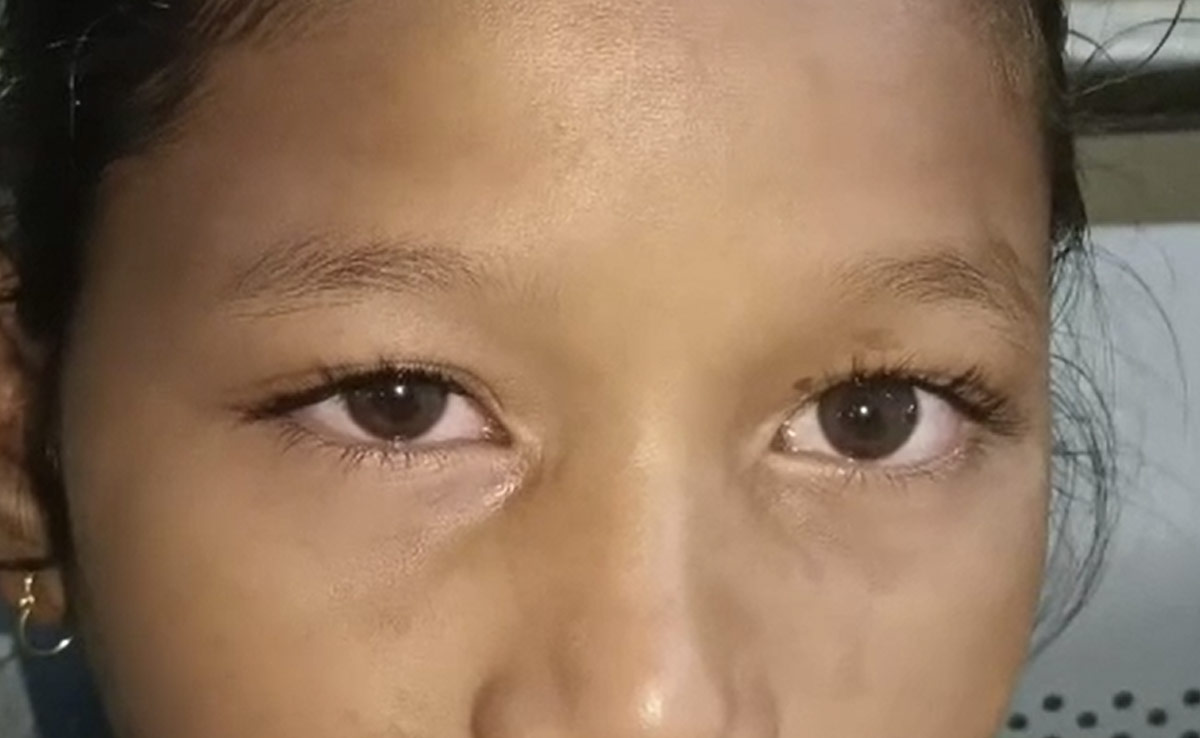 गरियाबंद में तेजी से पैर पसार रहा Eye Flu, पिछले तीन दिन में आए 500 से अधिक मामले