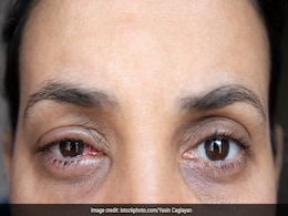 तेजी से फैलने लगा है आई फ्लू, जानिए Conjunctivitis से बचाव और राहत पाने के तरीकों के बारे में तेजी से फैलने लगा है आई फ्लू, जानिए Conjunctivitis से बचाव और राहत पाने के तरीकों के बारे में