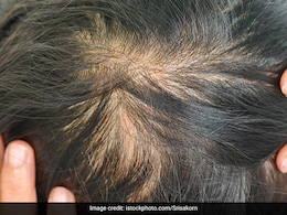 Hair Thinning? Try These Hacks To Slow Down Breakage & Dryness Hair Thinning? Try These Hacks To Slow Down Breakage & Dryness