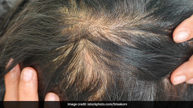 By following these hacks consistently, you can slow down hair thinning & prevent breakage
