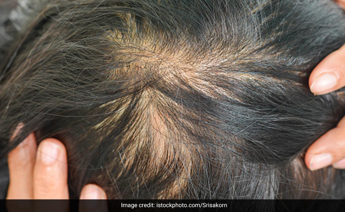 By following these hacks consistently, you can slow down hair thinning & prevent breakage