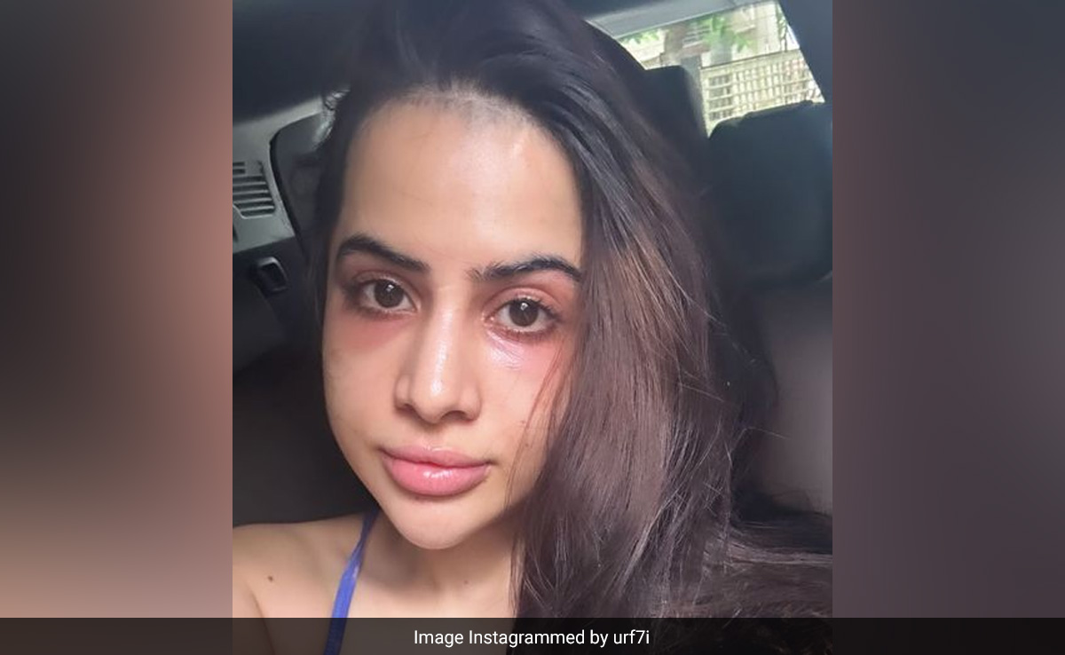 Uorfi Javed Shares Unfiltered Pic After Getting Undereye Fillers: "Was So Conscious..."