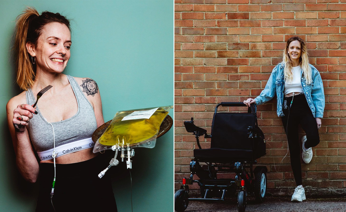 UK Chef Has Not Eaten Solid Meals For 8 Years Due To Rare Condition