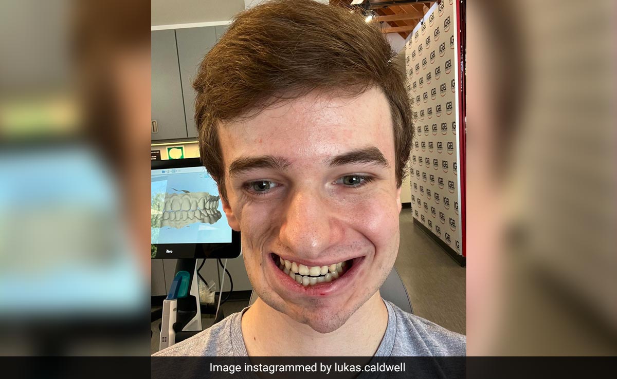US Teen Fighting Rare Condition That Has Caused His Half Face To Cave In