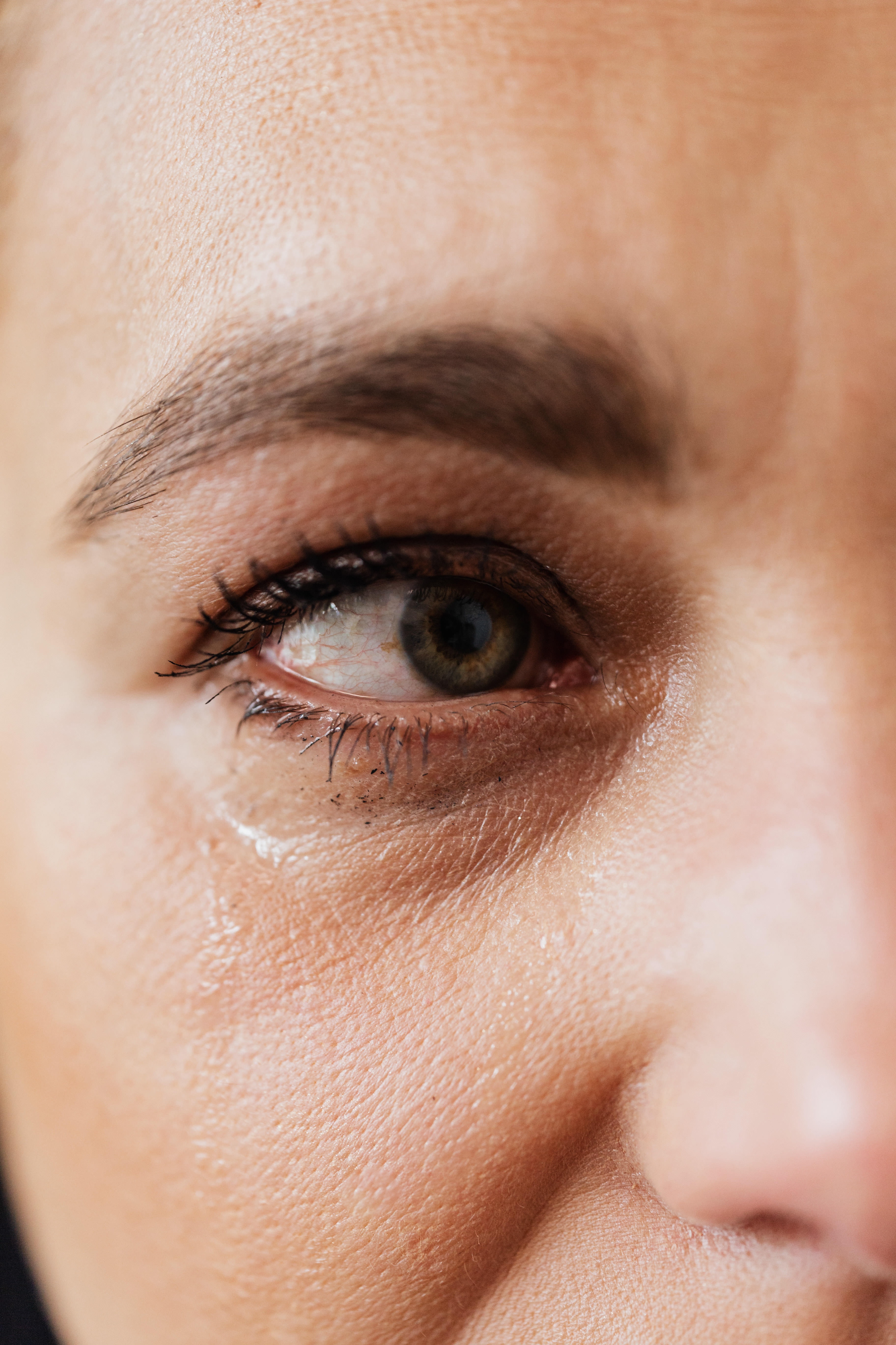 Conjunctivitis Surge in Chennai