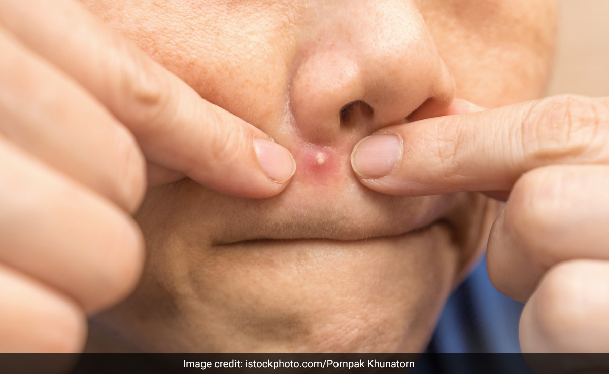 मुंहासे से घिरे चेहरे पर इन 5 चीजों को लगाकर Pimples से पा सकते हैं छुटकारा, नहीं दिखेगा एक भी दाना 