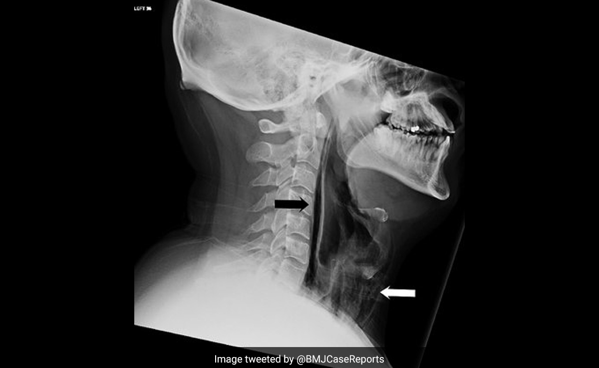 When A British Man Blew A Hole In His Throat After Holding In A Sneeze