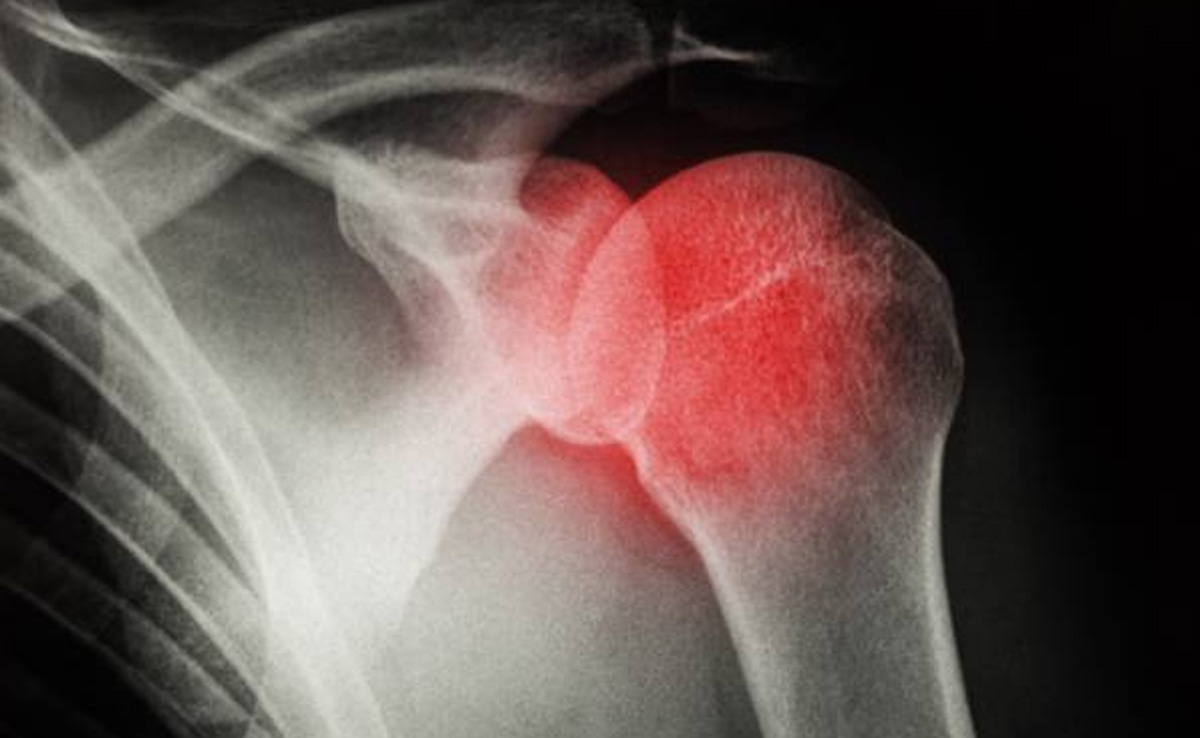 Dislocated Shoulder: कंधा उतरने (कंधा खिसकने) पर होता है तेज दर्द, क्‍यों उतर जाता है कंधा, जानें कारण, लक्षण, रिस्क फैक्टर और बचाव के उपाय