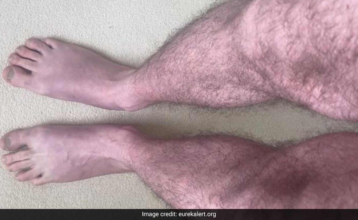 Unusual Case Of 'Blue Legs' In Long Covid Patient Seen: Report