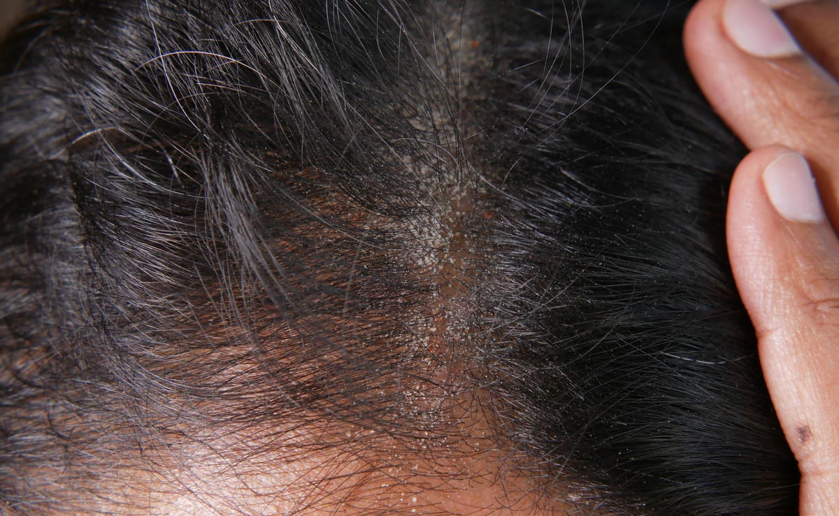 सिर में भर गए हैं डैंड्रफ और नजर आती है सफेदी, तो फ्रिज से निकालकर आज ही लगा लीजिए यह कमाल की चीज